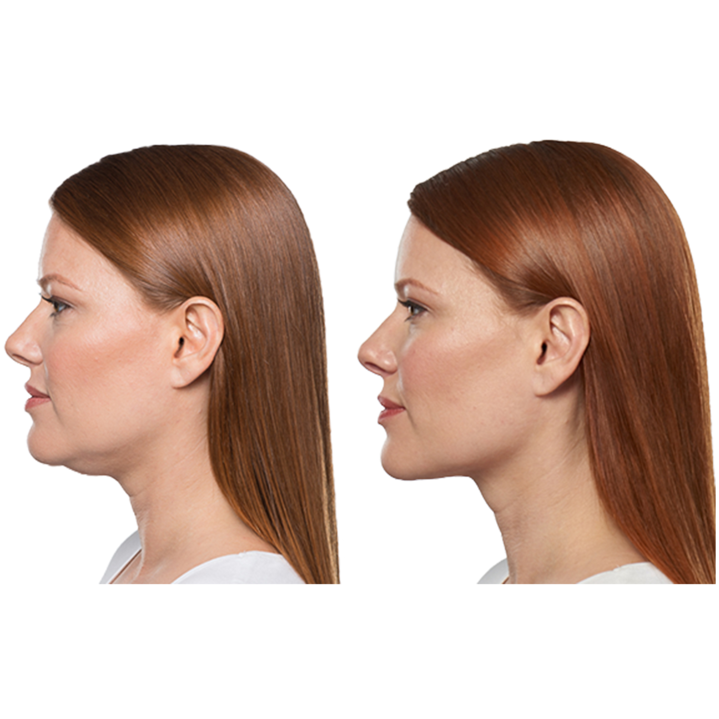 Kybella