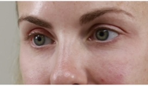 After-Eyes Result