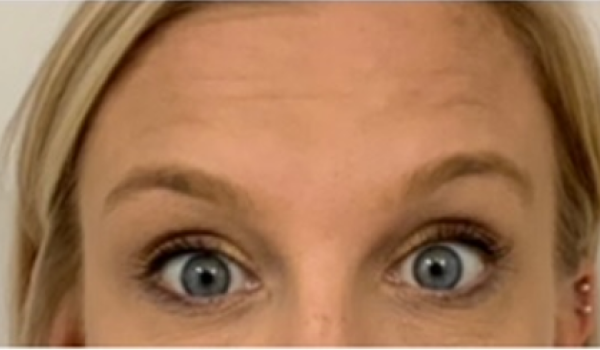 After-Forehead Result