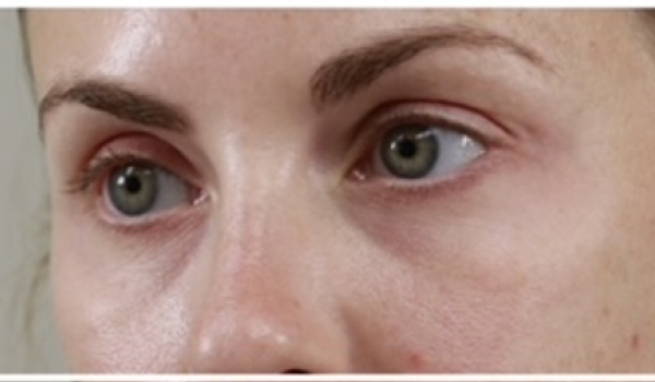 Before-Eyes Result