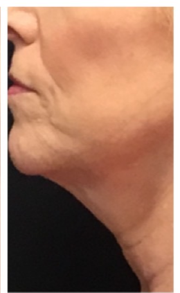 After-Chin Result