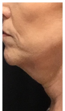 Before-Chin Result