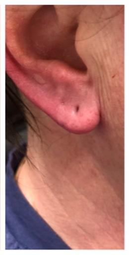 After-Ears Result