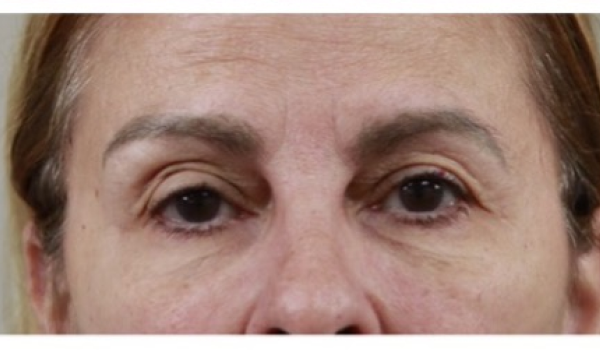 After-Eyes Result