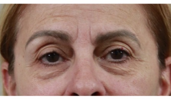 Before-Eyes Result