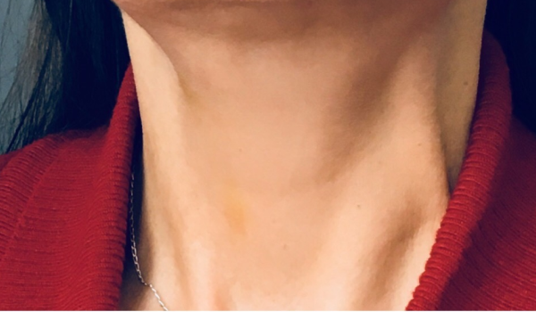 After-Neck Result