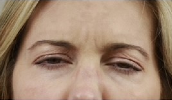 After-Forehead Result