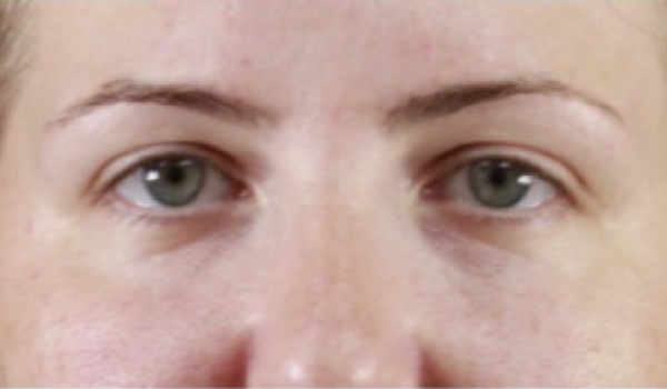 After-Eyes Result