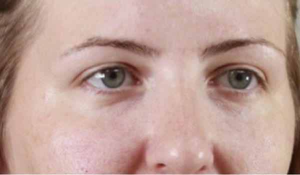 After-Eyes Result