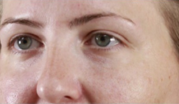 After-Eyes Result
