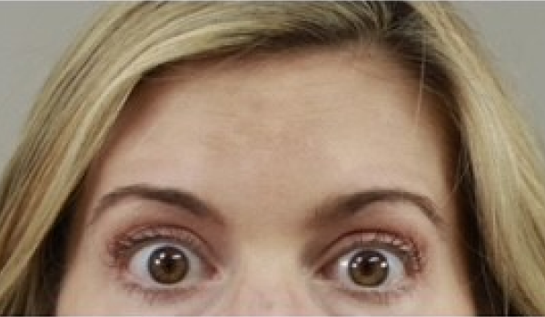 After- Forehead Result