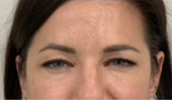 After- Forehead Result