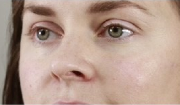 After-Cheeks Result