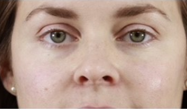 After-Cheeks Result
