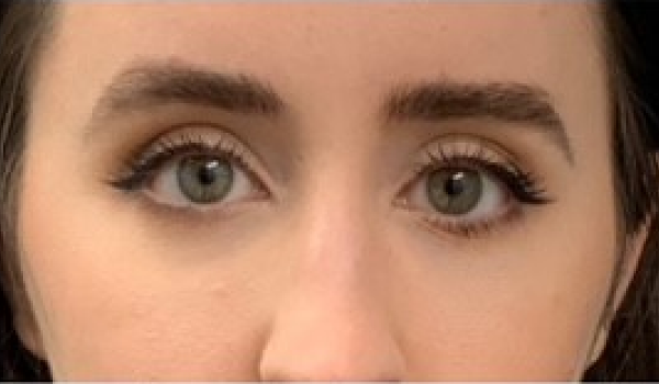 After-Eyes Result
