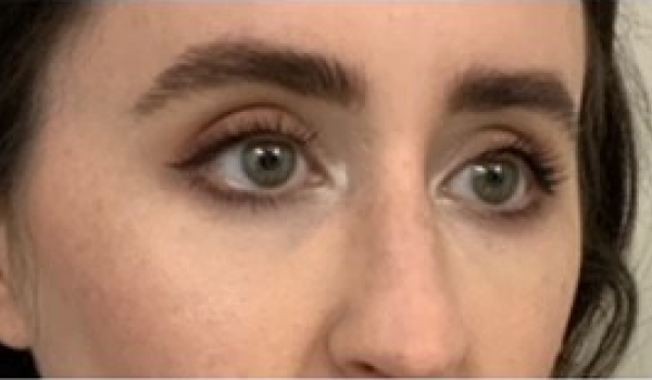 After-Eyes Result