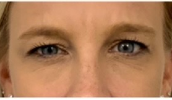 After-Forehead Result