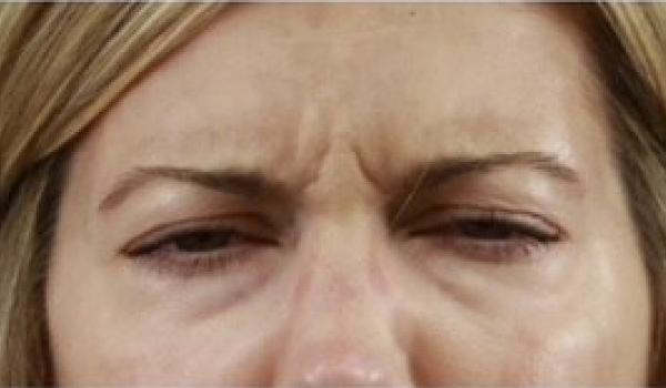 Before-Forehead Result