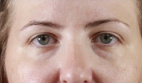 Before-Eyes Result