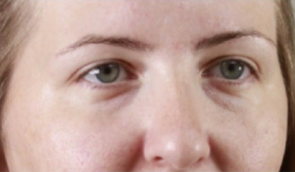 Before-Eyes Result