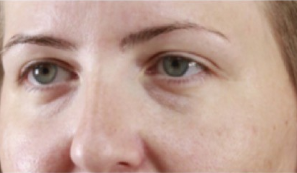 Before-Eyes Result