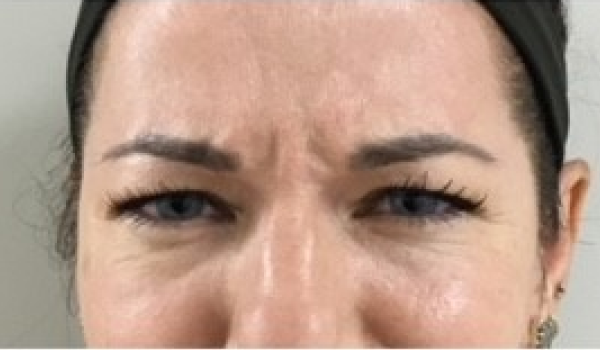 Before- Forehead Result