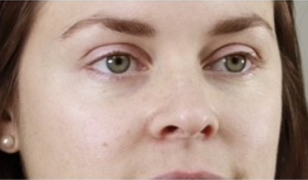 Before-Cheeks Result