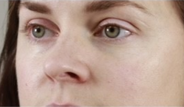 Before-Cheeks Result