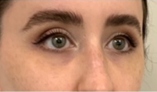 Before-Eyes Result