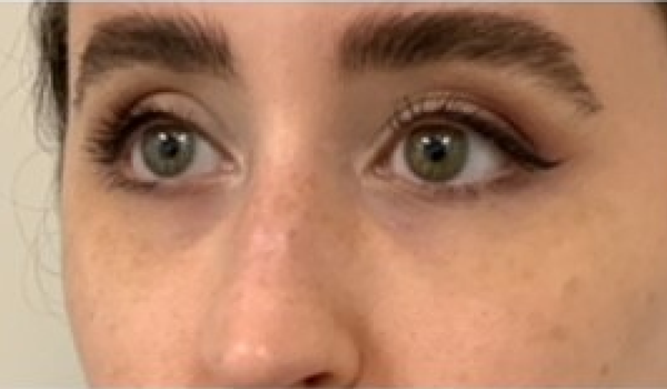 Before-Eyes Result