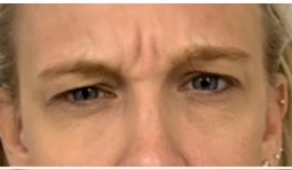 Before-Forehead Result
